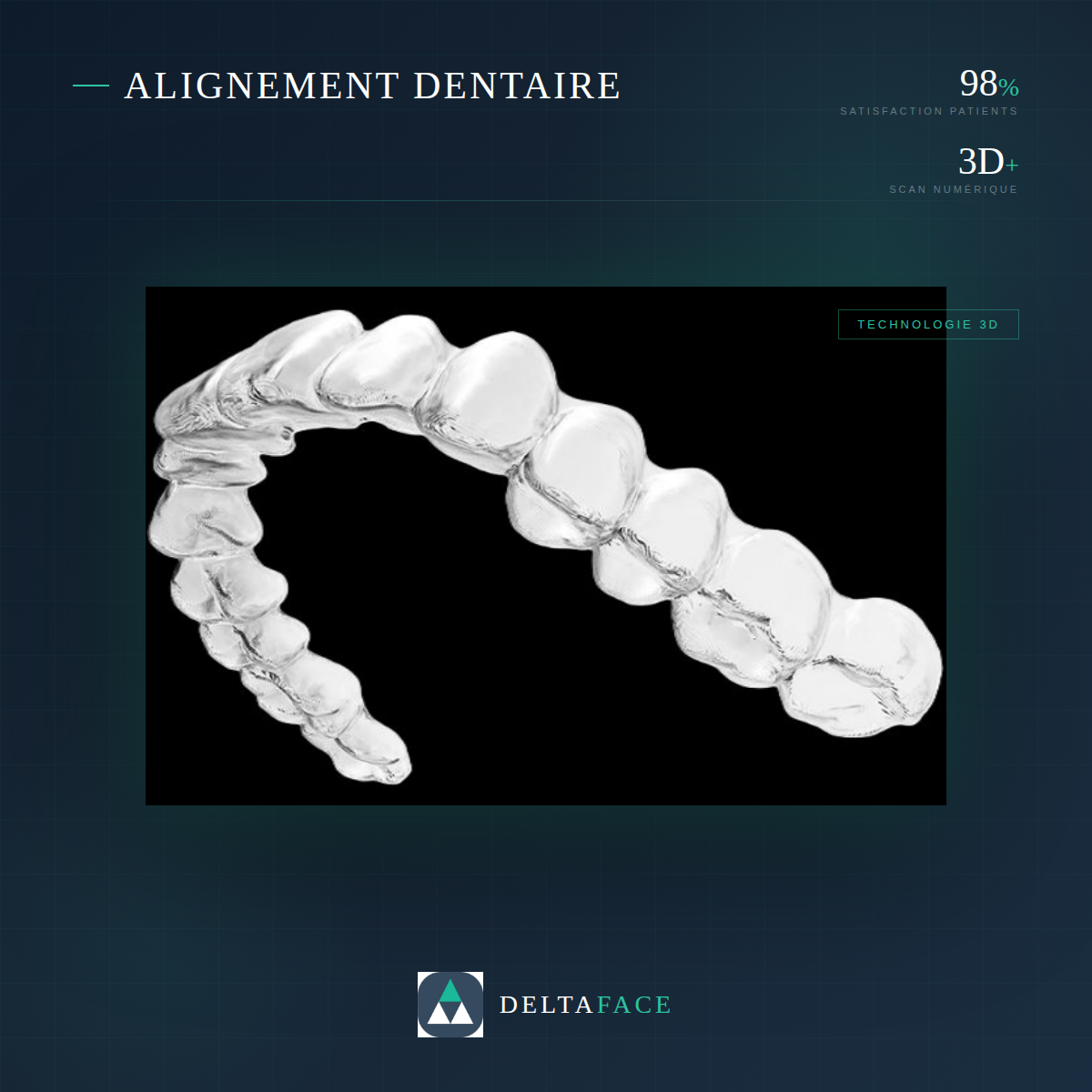 Set-up orthodontique pour fabrication de gouttières d'alignement