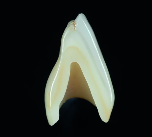 Couronne ceramo-ceramique zircone