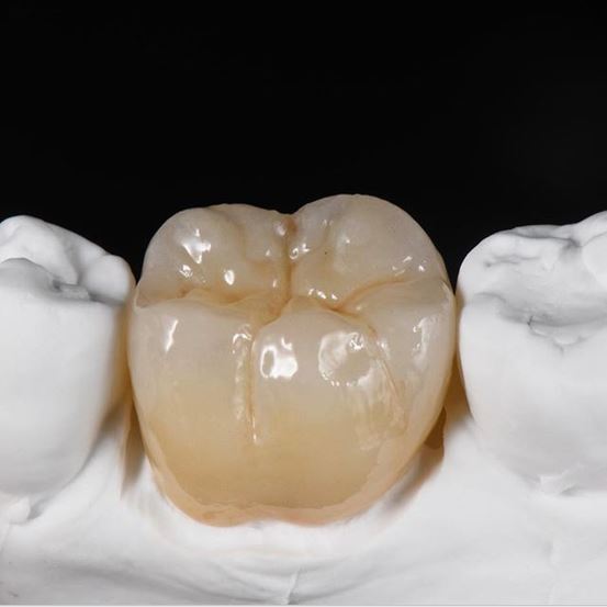 Couronne zircone multicouche