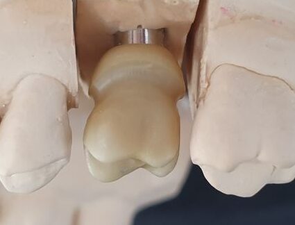 Pilier personnalisé en zircone sur implant